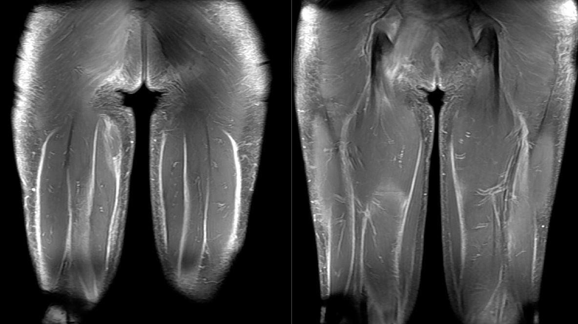 Figure 2 for case Systemic sclerosis with diffuse fascitiis